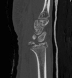 Radiocarpal Dislocation CT 2